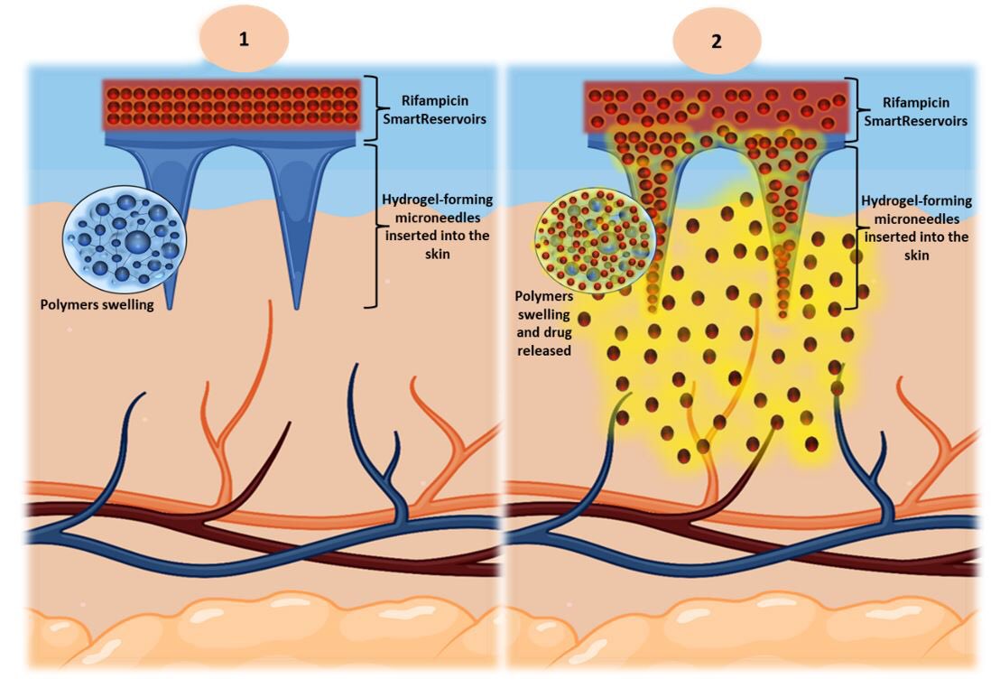 Delighted to share our latest research at @pharmacyatQUB on “Novel #SmartReservoirs” for hydrogel-forming #Microneedles published in @JMaterChem B. Enjoy reading more about this novel smart system 👇. pubs.rsc.org/en/content/art… #LoveQUB #Transdermal