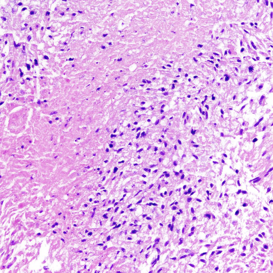 CraigHorbinski's tweet photo. Cerebellar mass in an older patient. Histology and genomic copy number assessment are shown. Diagnosis?
Hint #1: methylation profiling was required to confirm.
Hint #2: Harry, Peter, And Paul all agree that methylation profiling is awesome.😄
#pathology #neuropath #PathTwitter https://t.co/VAvH8aG46A