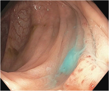 Michelle Baliss et al conduct 'Endoscopic closure of pancreatico-colonic fistulas in a patient with persistent infected pancreatic necrosis and bacteremia.' videogie.org/article/S2468-… @balissmichelle @numanlaith @kiwanGIdoc @KaraRaphael