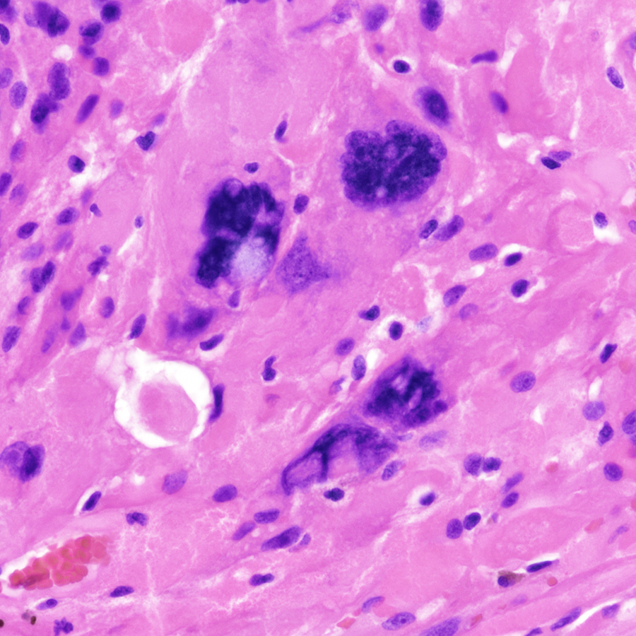 CraigHorbinski's tweet photo. Cerebellar mass in an older patient. Histology and genomic copy number assessment are shown. Diagnosis?
Hint #1: methylation profiling was required to confirm.
Hint #2: Harry, Peter, And Paul all agree that methylation profiling is awesome.😄
#pathology #neuropath #PathTwitter https://t.co/VAvH8aG46A