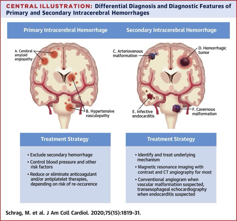 Spontaneous intracerebral hemorrhage

~15% of all strokes. 

HTN is the strongest risk factor. 

Ddx:
⭐️HTN: basal ganglia, thalamus, pons, cerebellum
⭐️Cerebral amyloid angiopathy: ⬆️age lobar/cerebellum
⭐️Coagulopathy: lobar
⭐️AVM: ⬇️age, lobar
⭐️Venous sinus thrombosis 
⭐️Mets