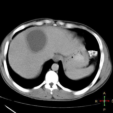 Gazal6849's tweet image. 🟣𝘾𝙇𝙄𝙉𝙄𝘾𝘼𝙇 𝙎𝘾𝙀𝙉𝙀𝙍𝙄𝙊:-

🧬A 40yr old male presented with #Fever ,Right upper quadrant pain &amp;amp; mild jaundiced eyes. He is having history of bloody diarrhea few weeks back.

#CT_scan of liver is shown👇

🦠What is likely #diagnosis❓❓

Pic @Radiopaedia #medEd #medx