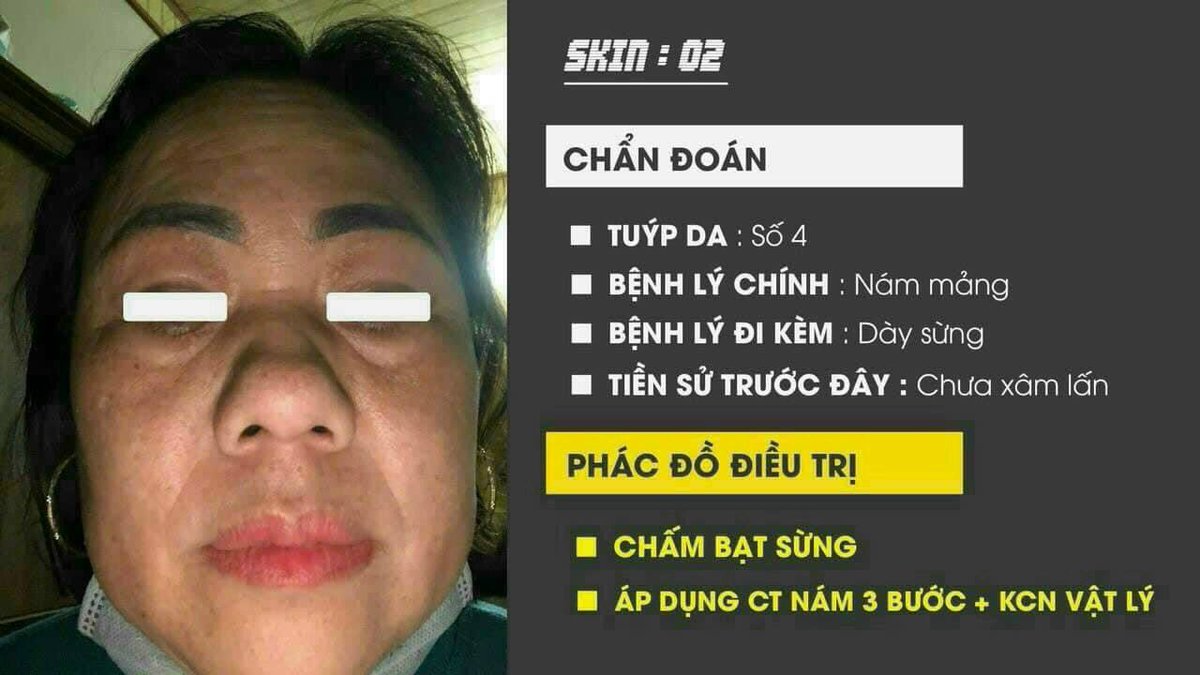 bapbebong1's tweet photo. • VÌ LÀ BỆNH LÝ HIỂN THỊ HẾT TRÊN NỀN DA CỦA BỆNH NHÂN CHỨ KHÔNG NHƯ CÁC BỆNH LÝ NỘI KHOA MÀ MÌNH PHẢI SIÊU ÂM HAY CHỤP CHIẾU THÌ MÌNH MỚI BIẾT ĐƯỢC.
• VẬY NÊN THĂM KHÁM ONLINE QUA HÌNH ẢNH VẪN LÀ PHƯƠNG PHÁP HỮU HIỆU TỐI ƯU CHO NHỮNG BỆNH NHÂN Ở XA https://t.co/DjGVmfxv7t