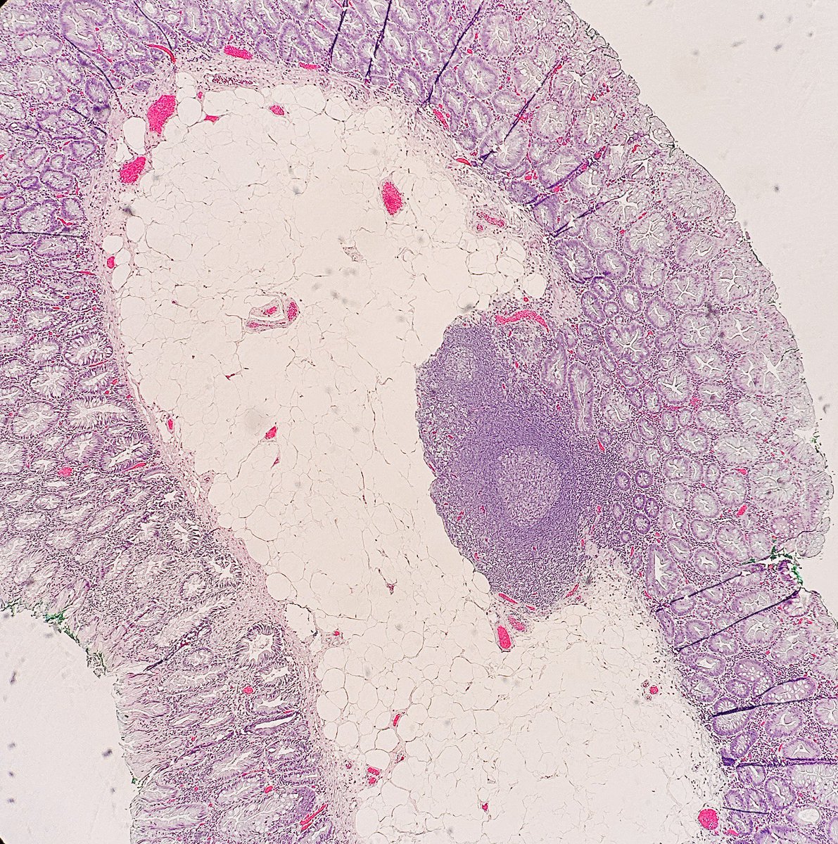 Path4People's tweet photo. I am a benign tumor 

I am often found on back + extremities

I can also be found ⬇️ 

Who am I? 🤔 

#pathagonia #pathx #gipath #gastroenterology #medx #surgpathx #gensurg #surgx #colonoscopy #pathtwitter #colon #colonpolyp #medstudentx #medical #softtissue #medicine #pathology https://t.co/8BY2IeXeGU