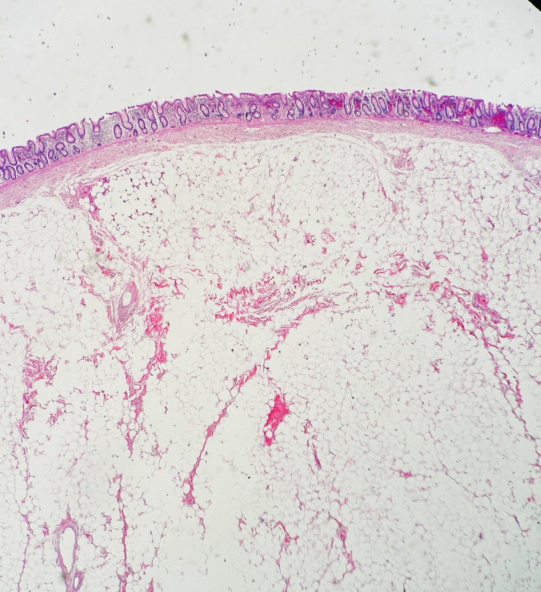 Path4People's tweet photo. I am a benign tumor 

I am often found on back + extremities

I can also be found ⬇️ 

Who am I? 🤔 

#pathagonia #pathx #gipath #gastroenterology #medx #surgpathx #gensurg #surgx #colonoscopy #pathtwitter #colon #colonpolyp #medstudentx #medical #softtissue #medicine #pathology https://t.co/8BY2IeXeGU