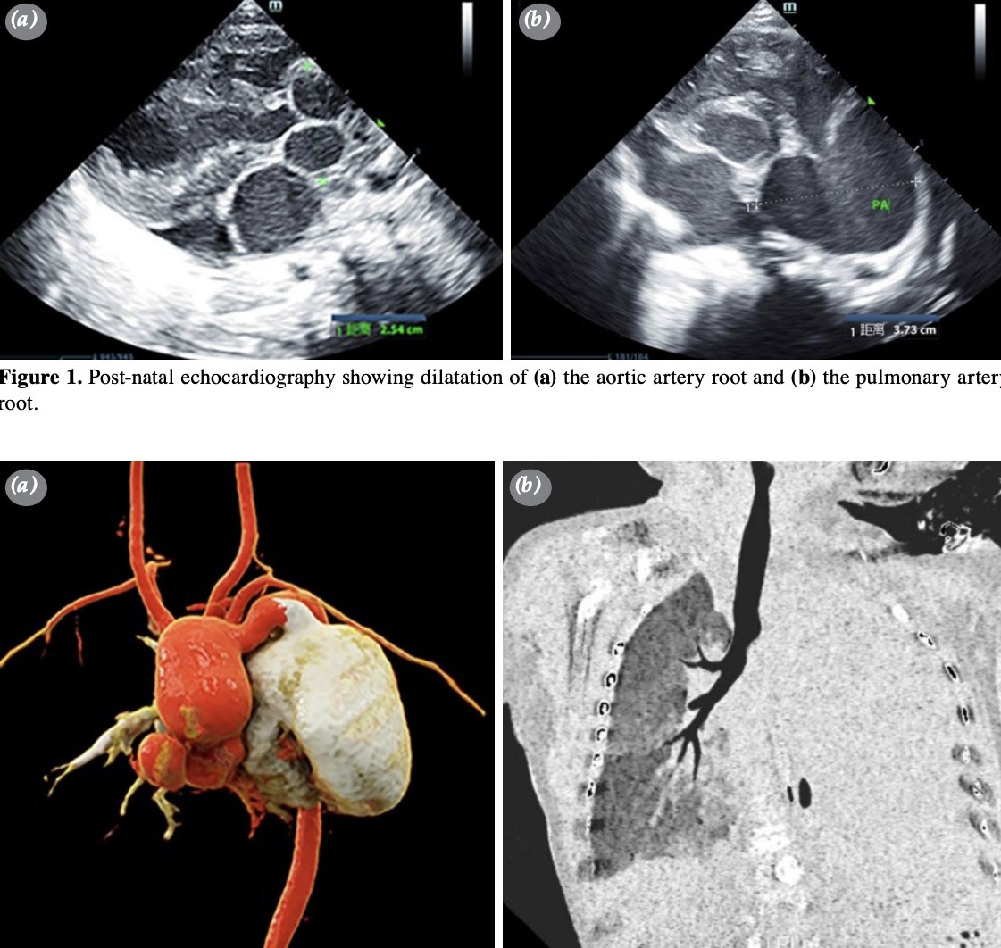 tjtcvs's tweet photo. Early-onset Marfan syndrome with aortic dilatation and giant pulmonary artery aneurysm: A case report

https://t.co/2z4jAoyuY7 https://t.co/Pf1qC6picB