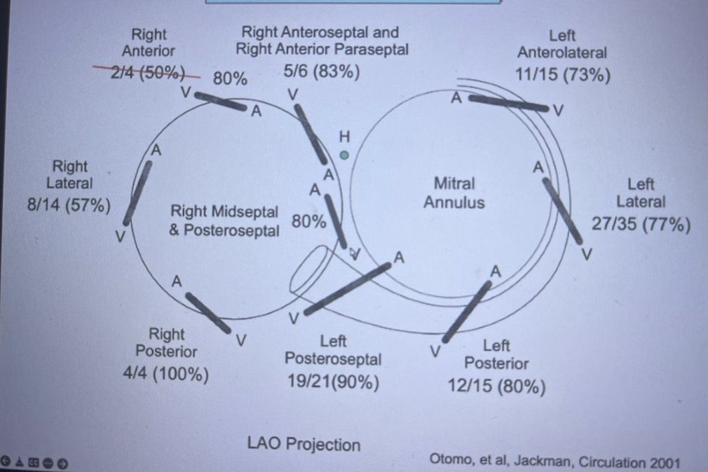 10 yom pt , PS #WPW. See classic oblique course of AP. Retro earliest activation at CS 7-8 at PS to Post LA. Succesful ablation close to V insertion at PS right side. 90% APs are oblique at this area. If you don’t draw it in your mind.. No 3D available Only XR @hospitalposadas