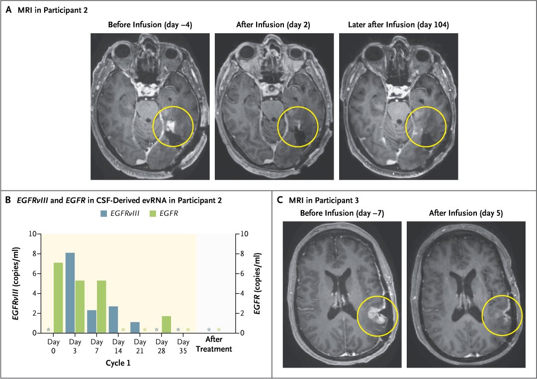 Brief Report: Intraventricular CARv3-TEAM-E T Cells in Recurrent Glioblastoma nej.md/3VnjUIq #Neurology