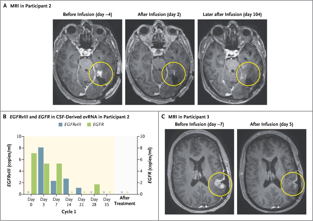 NEJM's tweet photo. Brief Report: Intraventricular CARv3-TEAM-E T Cells in Recurrent Glioblastoma https://t.co/kYAm6U9DR1 

#Neurology https://t.co/Ua42w0rQwg