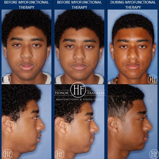 Look at the sponatenous improvement so far of this 16 year old male patient's facial shape.After he was evaluated by an Allergist and ENT on her team.