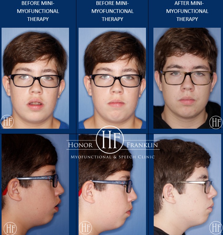 Do u know how 2 eliminate a hyperactive mentalis muscle? Learn more here:
( courses.honorfranklin.com/.../MYO-Lip-Co… )