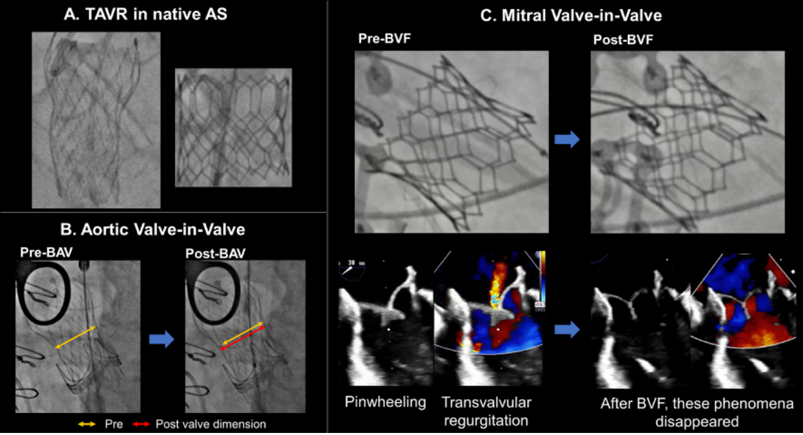 Just out! Review of 'THV Deformation: Clinical implications and consideration' describing from in-vitro findings to mitigation strategies sciencedirect.com/science/articl… Here is 50 free access for everyone! authors.elsevier.com/a/1ilV43Fxsder… @bapat_savrtavr @JoaoLCavalcante @MHIF_Heart @OhnoTuri