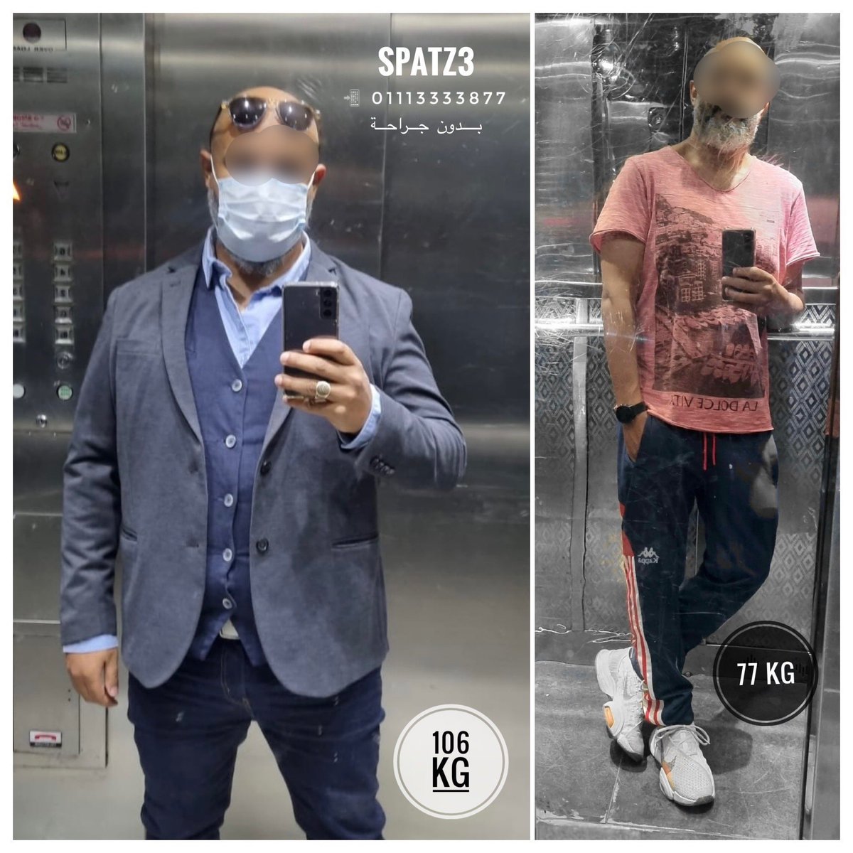 MohamedAbeid's tweet photo. #SPATZ3 the best #weightloss solution!
94% EWL
27% TWL
Complete resolution of:
HTN ✅
NAFLD ✅
OSA ✅
Much improved QoL ✅
Now a marathon runner 🏃♂️ https://t.co/Nzg78Db83W