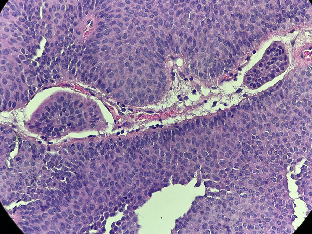 They say low grades can (rarely) invade… is this an example ? #gupath