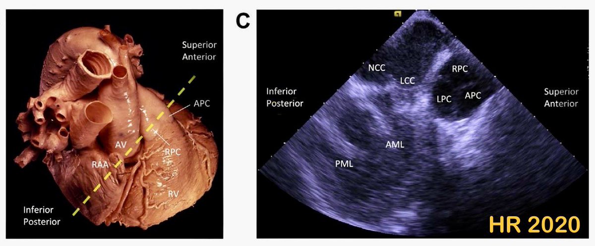 Correct answer: Non coronary + Right pulmonary

ICE view from the RAA adjacent to the Ascending Ao 👇

At the top of the image, the PV leaf closest to the transducer = right pulm

The NCC always closest to transducer from any RA/RAA vantage point. #ICEeyes #Epfellows