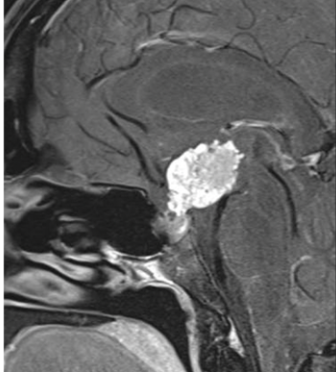 A choroid plexus papilloma is a benign, lobulated, intraventricular mass arising from choroid plexus epithelium that may disseminate via CSF.

 #MedTwitter #Neurosurgery #NSGY #surgery