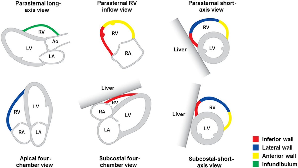 Different walls of the right ventricle seen on various #echofirst views.
#POCUS #FOAMed #MedEd 
Courtesy: Venkatachalam S, et al. Echocardiography. 2017