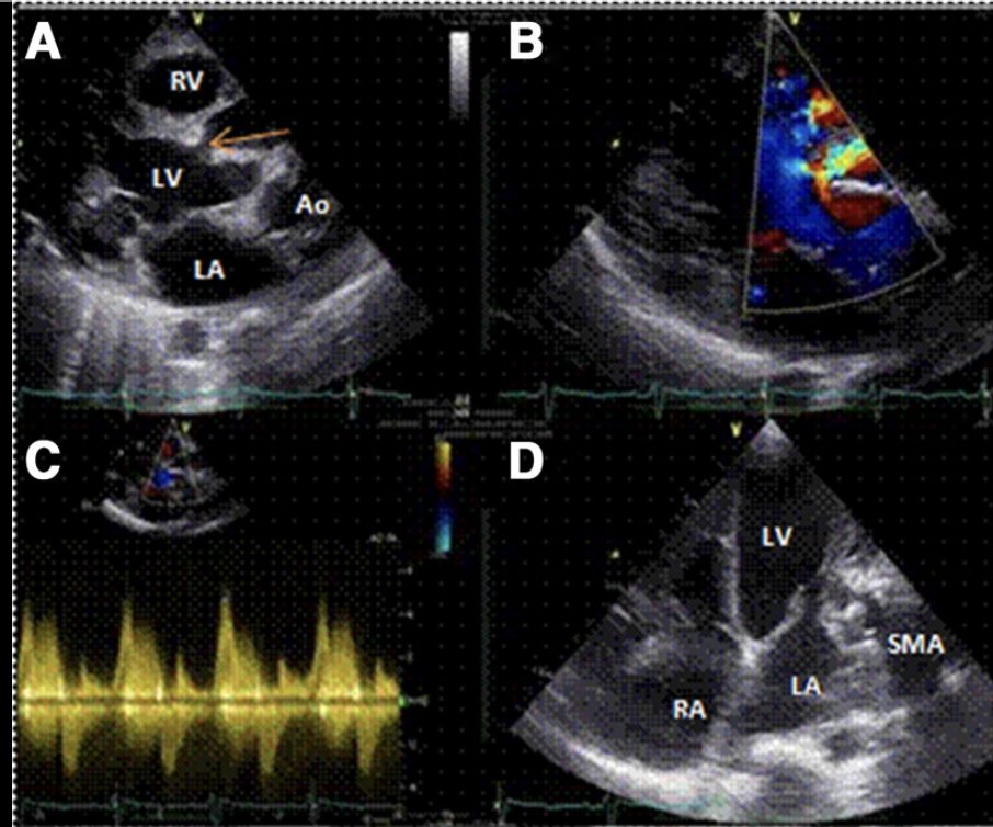 EHJ-IMP Editor-in-Chief (@ehjimpeic) on Twitter photo #EHJIMP results are out!!! ‼️‼️
--> TT/TOE is the first choice
what do you see now in the picture?
<a href="/alessia_gimelli/">Alessia Gimelli</a> <a href="/JGrapsa/">Julia Grapsa MD, PhD</a> <a href="/EZancanaroMD/">Edoardo Zancanaro MD</a> <a href="/ESC_Journals/">European Society of Cardiology Journals</a> <a href="/escardio/">European Society of Cardiology</a> <a href="/ESC_Lavinia/">Lavinia Baciu</a> <a href="/VDelgadoGarcia/">Victoria Delgado</a> <a href="/denisamuraru/">Denisa Muraru</a> <a href="/SilCastelletti/">Silvia Castelletti</a> <a href="/ShehabAnwer/">Shehab Anwer, MD</a> <a href="/echo_stepbystep/">Vladyslav Kavalerchyk 🇺🇦</a> <a href="/EchoSoliman/">Hatem Soliman, FRCP, FEACVI, FASE, FHEA</a>
Poll ⬇️ #EHJIMP results are out!!! ‼️‼️
--> TT/TOE is the first choice
what do you see now in the picture?
<a href="/alessia_gimelli/">Alessia Gimelli</a> <a href="/JGrapsa/">Julia Grapsa MD, PhD</a> <a href="/EZancanaroMD/">Edoardo Zancanaro MD</a> <a href="/ESC_Journals/">European Society of Cardiology Journals</a> <a href="/escardio/">European Society of Cardiology</a> <a href="/ESC_Lavinia/">Lavinia Baciu</a> <a href="/VDelgadoGarcia/">Victoria Delgado</a> <a href="/denisamuraru/">Denisa Muraru</a> <a href="/SilCastelletti/">Silvia Castelletti</a> <a href="/ShehabAnwer/">Shehab Anwer, MD</a> <a href="/echo_stepbystep/">Vladyslav Kavalerchyk 🇺🇦</a> <a href="/EchoSoliman/">Hatem Soliman, FRCP, FEACVI, FASE, FHEA</a>
Poll ⬇️