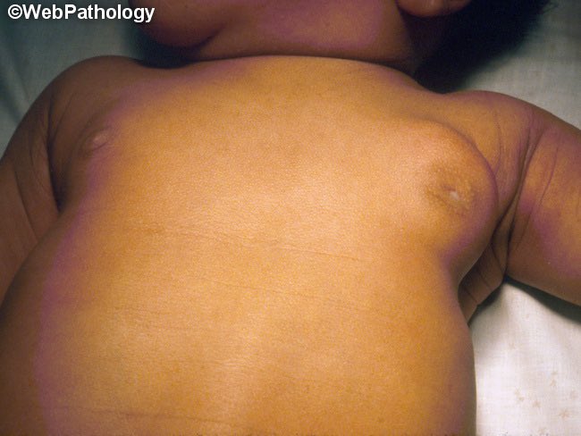 DrMedica_13's tweet photo. #Medical_Case🦠
“Gynecomastia” in neonates is due to:
A) Mother intake of estrogen
B) Mother intake of progesterone
C) GnRH
D) Gonadotropins
#Pediatrics #Neonatology #MedicalTwitter" https://t.co/SshTDZ9d1s