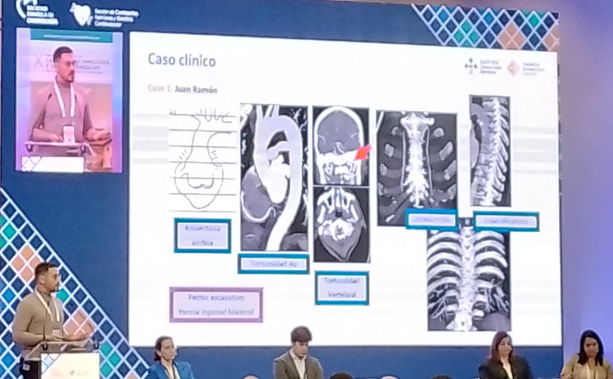 Unidad Cardiopatías Familiares HCUVA (@cardiopatiash) on Twitter photo Desentrañando la complejidad de las aortopatias familiares con la Dra Maite Tomé y <a href="/giselateixido/">gisela teixido</a>. Mas allá de la presentación vascular Desentrañando la complejidad de las aortopatias familiares con la Dra Maite Tomé y <a href="/giselateixido/">gisela teixido</a>. Mas allá de la presentación vascular