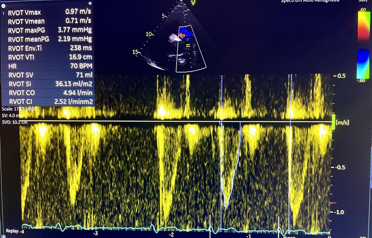 NMerke's tweet photo. Next #echodirst step is ๐ at right โค๏ธ volume to start #EchoMath using #Volumetric https://t.co/AUtUhXVbAv