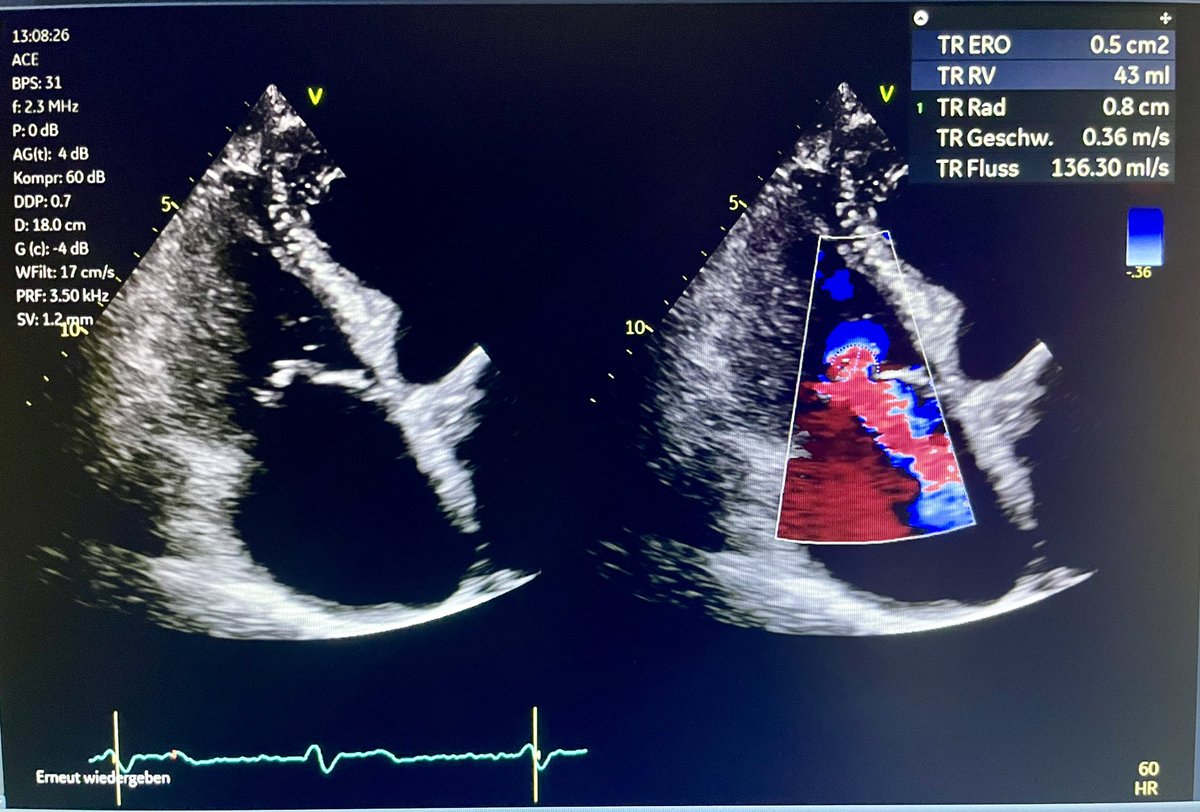 NMerke's tweet photo. #echofirst can try PISA in TR, but ONLY if convergent zone is hemispherical as we us mathematical equation to calculate โญ๏ธ
In most of relevant TR cases PISA is not feasible https://t.co/PT6TLj3529