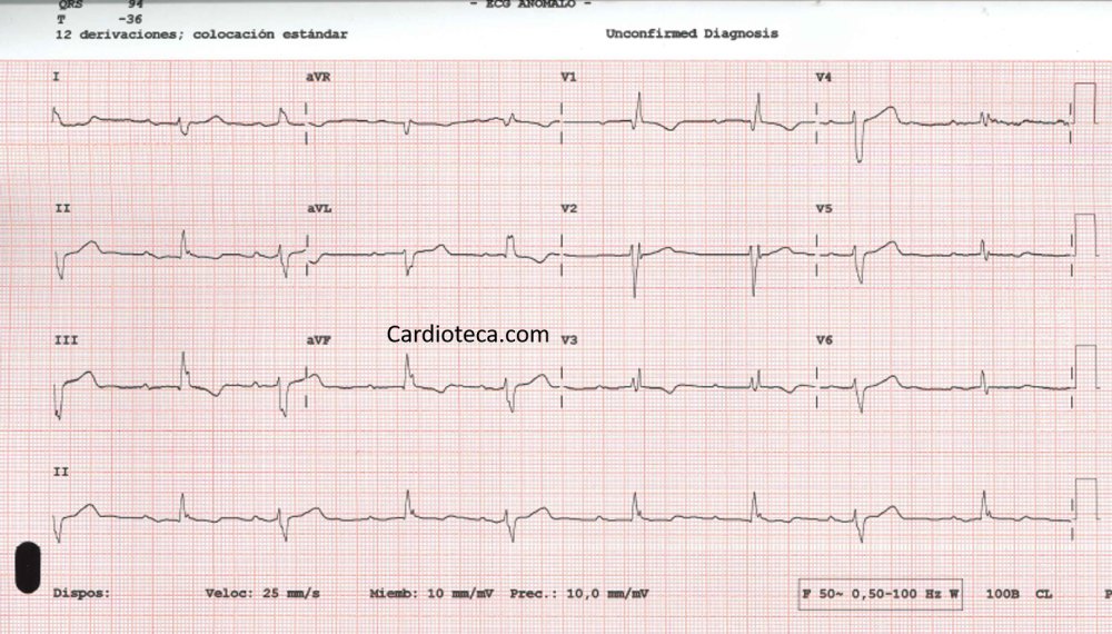 cardioteca's tweet photo. 🆕❤️ #ECGCardioTeca 569 - 85 años. Ingresa para TAVI. Al ingreso tiene un bloqueo de rama izquierda. El implante sin incidencias. Día del alta: asintomático.

 ✅ Bloqueo alternante de rama 
👉 https://t.co/ZvjE3zK294

#cardiologia #cardiotwitter @HiguerasJavier #ecg https://t.co/3yb9qA2YMg