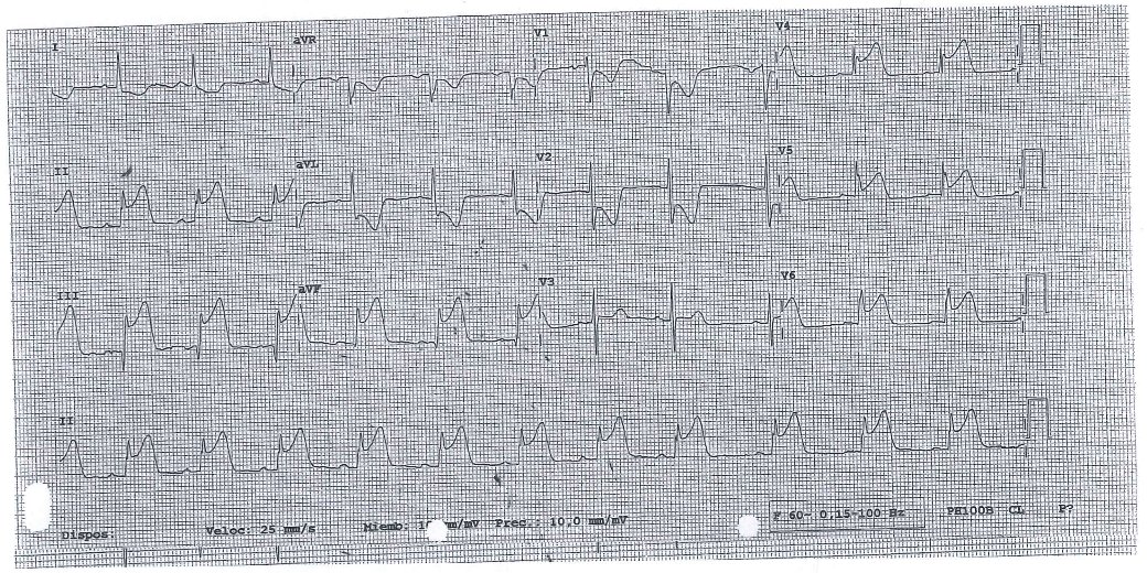 12_Derivaciones's tweet photo. 🧔♂️ Varón de 50 años, diabético y dislipémico acude por dolor torácico
🎯 El ECG muestra infarto inferior (segmento ST elevado en II, III y AVF), lateral (V4-V6) y "posterior" (descenso especular V1 y V2)
📚 Preguntado #MIR2016 - #MIR2017 https://t.co/FHcPHVQtri