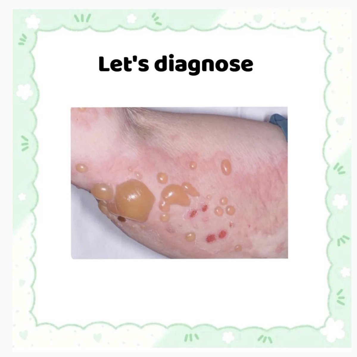 DrMedica_13's tweet photo. #DermaMed🍀
A 68yr old patient presented with itchy tense skin blisters on the extensor aspect of limbs as shown below.
What could be the “diagnosis”?
A) Pemphigus vulgaris
(B) Dermatitis herpetiformis
(C) Bulous pemphigoid
(D) Pemphigus foliaceous
#Diagnosis #MedEd #MedX https://t.co/BD3wCKpS0p