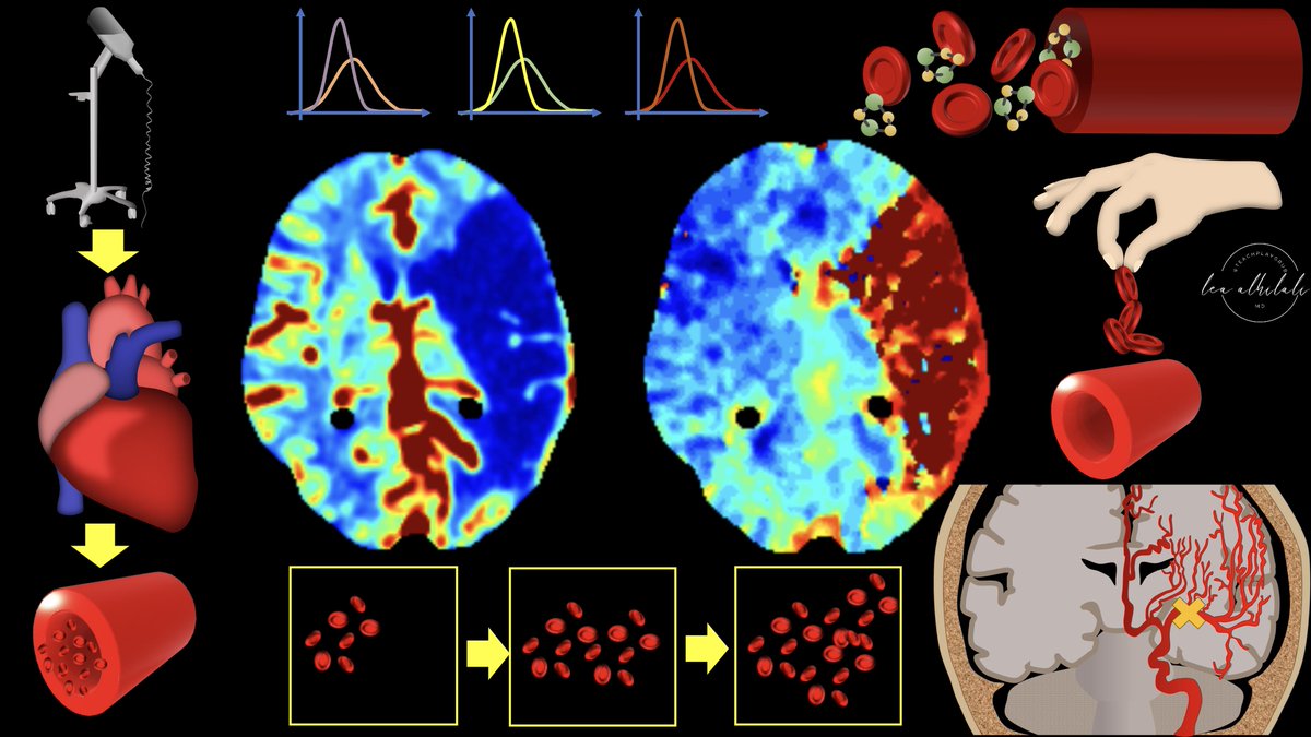 1/My hardest thread yet! Are you up for the challenge? How stroke perfusion imaging works! Ever wonder why it’s Tmax & not Tmin? Do you not question the images & let RAPID read the perfusion for you? Not anymore! Here's all you need to understand perfusion imaging!