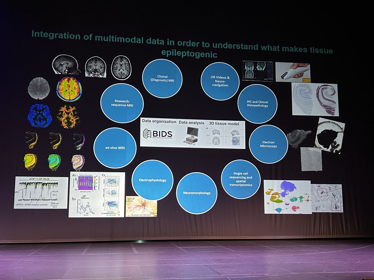 ✨Alejandra Sierra Lopez <a href="/MultiscaleG/">Multiscale Imaging Group</a>✨
✨Tarja Malm @LabMalm ✨very interesting talk about 'Multiscale assessment of epileptogenicity in human brain tissue' 
🏥excellent &amp; fruitful collaboration
 <a href="/UEF_BRU/">UEF Brain Research Unit</a>
#KES2024 
#kuopioepilepsy
<a href="/Pshyvinvointi/">Pohjois-Savon hyvinvointialue</a>
<a href="/UniEastFinland/">University of Eastern Finland</a>
#Neurology