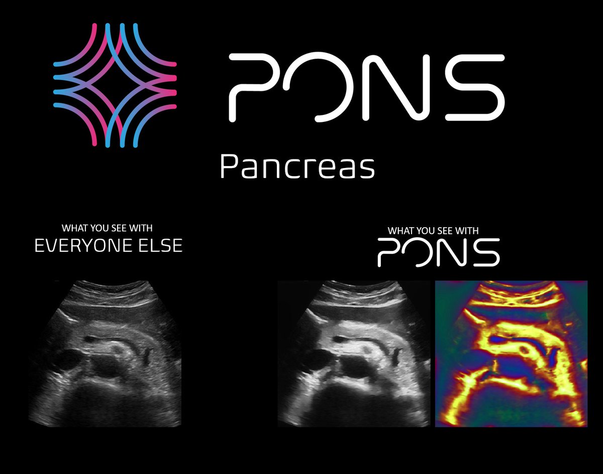 PONS: Revolutionizing drug discovery with continuous, real-world data on early-stage disease progression captured through AI-enhanced point-of-care ultrasound #DiGiTALhealth #HIMSS24 #biomarker #biotech #Bitcoin