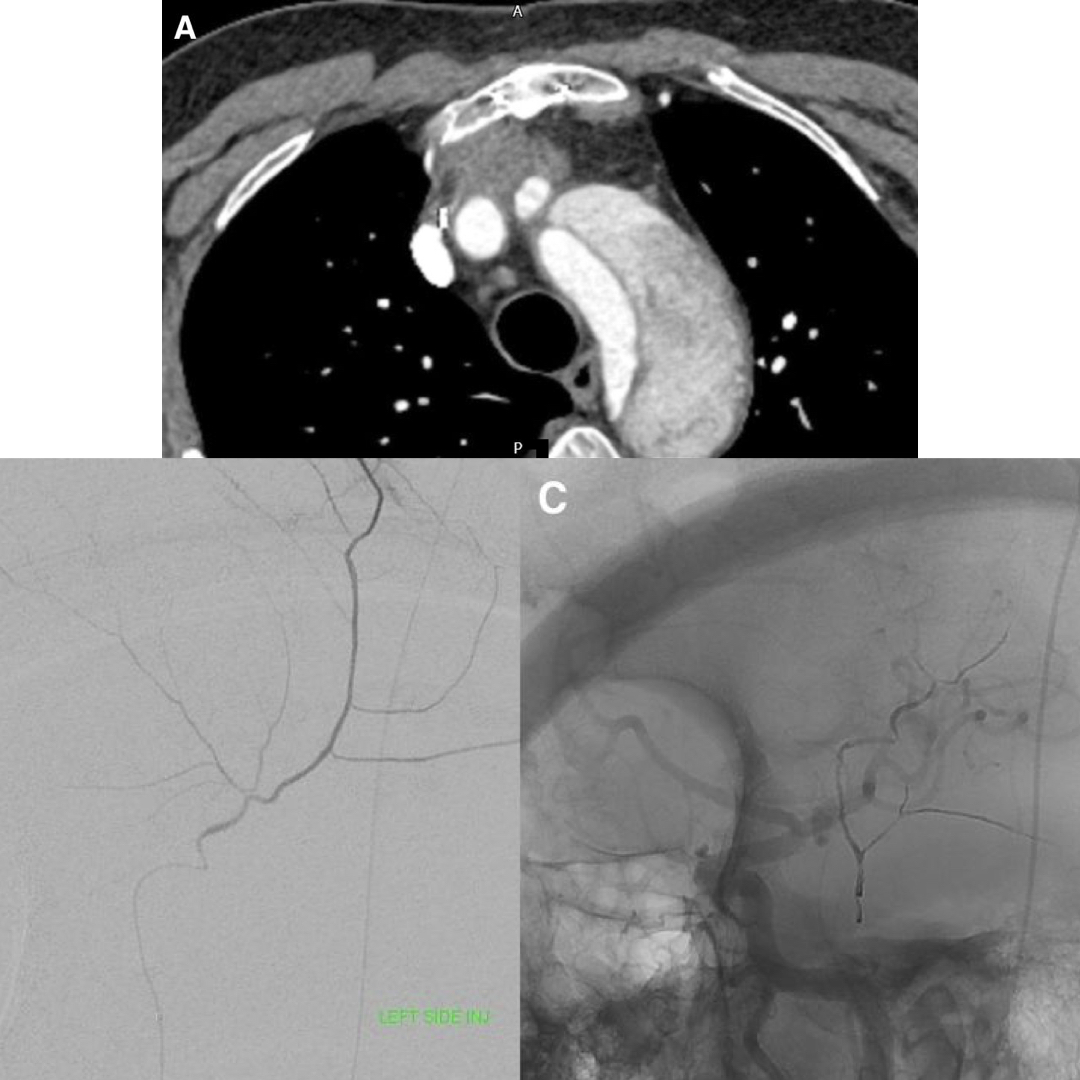 🧠💡 Type A aortic dissection blocking access to MMA embo for #CSDH? Discover the innovative use of a direct superficial temporal artery puncture for middle meningeal artery embolization in treating chronic subdural hematoma (#CSDH). WHAT?!? READ @JNIS-BMJ bit.ly/3PiKi2y