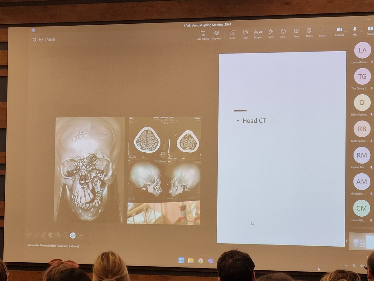 Dr Alex Awokuah talk on a case of Difficult Airway in a Child secondary to Mucormycosis in Ghana
#SPAN2024
