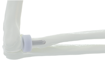 BioPolyOrtho's tweet photo. ‼ RADIAL HEAD FDA CLEARANCE ‼

We are pleased to announce we have received FDA clearance on our BioPoly Radial Head system! 

Read more below! 👇

https://t.co/qUKosHYQRU

#biopoly #radialhead #fdacleared #advancingmaterials #advancingoutcomes https://t.co/CmIWyZot1X