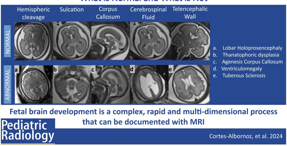 A tour de force article on fetal brain development by Camila. What a privilege to collaborate with these mighty rads and awesome friends. @bedoya3aleja JohnChoi @boschildrensrad @CincyKidsRad @mghfc @MGHImaging @CortesAlbornoz_ @PIRC_MGH