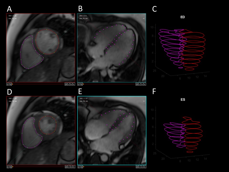 Pretty excited to share our work using MRI to study cardiac and cerebral responses to LBNP in POTS at @APSPhysiology in just a few weeks! Come see me at the Saturday evening's poster session (in the cerebral section). Here is one of the cool [cardiac] figures from the poster!