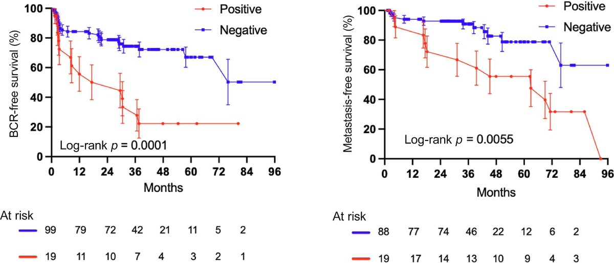 Cutting Edge Letters: Ultrasensitive Detection of Circulating Tumour DNA enriches for Patients with a Greater Risk of Recurrence of Clinically Localised Prostate Cancer Read it here: europeanurology.com/article/S0302-… @loki_phd @danbrewer @davidcwedge @harveerdev #Medtwitter #UroSoMe