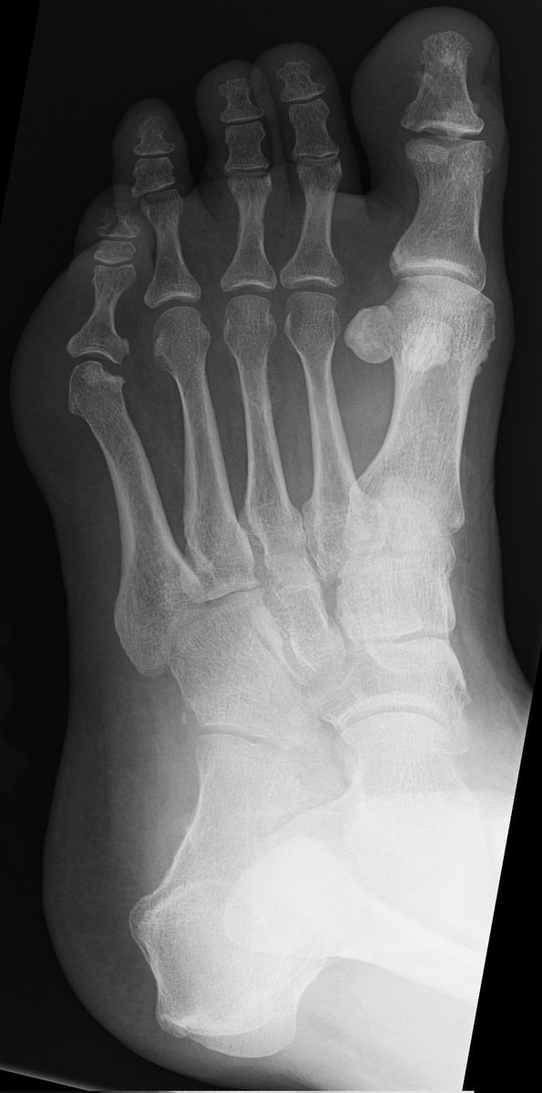 #CaseOfTheWeek...End‼️🥳‼️

☢️🩻☠️Case#10☠️🩻☢️

#FootPain #1MonthApart 

Best gifs requested! 😎

📲➡️➡️#Diagnosis❔❓❔

#FOAMRad #RadEd #MedEd #OrthoEd #OrthoTwitter @ssr_rwg @UWRadRes @AOFAS