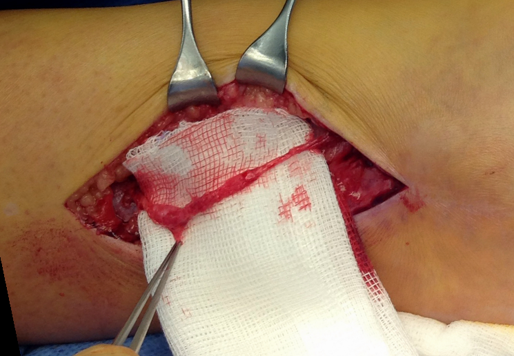 traumaticum's tweet image. A seriously pissed off superficial peroneal nerve following plate fixation of a distal fibula fracture. Index OP was over 2 years ago, and the patient has been plodding around with neuropathic pain since.

#orthotwitter #orthoX #orthopedics #orthopaedics