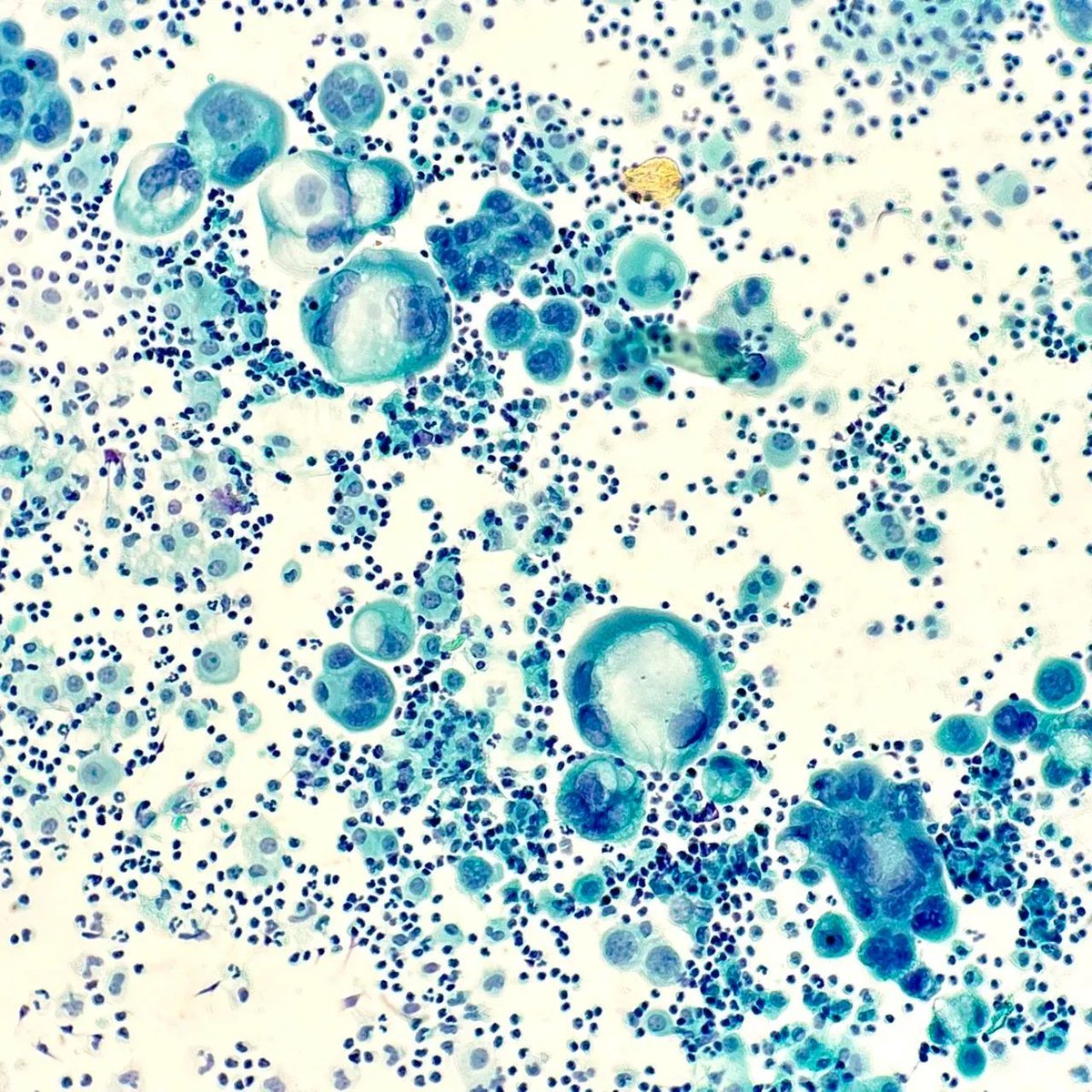 Pleural fluid revealing a metastatic tumor of what origin? Answer: buff.ly/3SePkPJ #PathArt #MedTwitter #PathTwitter