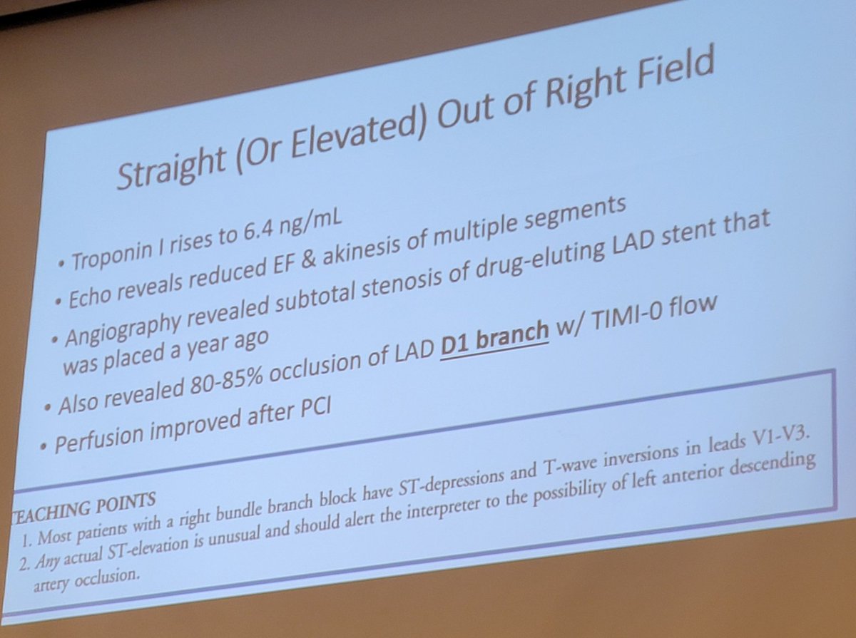 Jacob Miller NP CNS NRP (@jacobmilleracnp) on Twitter photo .<a href="/michaelsharmapa/">Michael Sharma, PA-C ⚕️🎙️</a> on ECGs: 
In addition to Sgarbossa's criteria for LBBB (and other #OMI equivalents), don't sleep on concordant STE in RBBB either! 
<a href="/AAENP2/">AAENP</a> #EmergNP24 .<a href="/michaelsharmapa/">Michael Sharma, PA-C ⚕️🎙️</a> on ECGs: 
In addition to Sgarbossa's criteria for LBBB (and other #OMI equivalents), don't sleep on concordant STE in RBBB either! 
<a href="/AAENP2/">AAENP</a> #EmergNP24