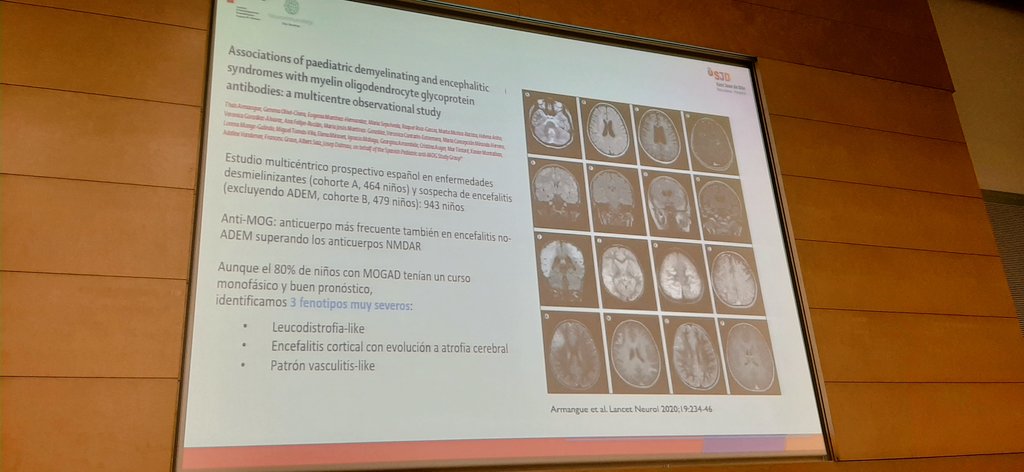 La encefalitis no ADEM puede llegar hasta el 20% de los casos y logramos diferenciar 3 patrones con un pronóstico peor al ADEM pubmed.ncbi.nlm.nih.gov/32057303/ #neuroimmunoclinic