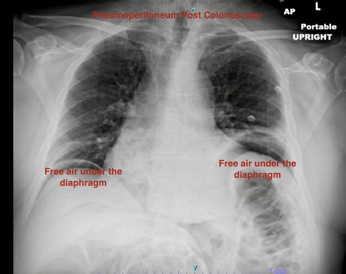 Reminder of risk of bowel #perforation w #colonoscopy. Procedure done for #LGIB by another provider -> diverticulosis & 2 < 5 mm polyps removed w cold biopsy forceps. Upright CXR ->readily visible free air under the diaphragm 2 d later. Surgery-> perf R colon.