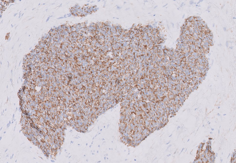 24yo male, with peritoneal 'carcinomatosis' Desmin and CK are positive What is the most likely molecular alteration? Poll in next tweet #PathTwitter