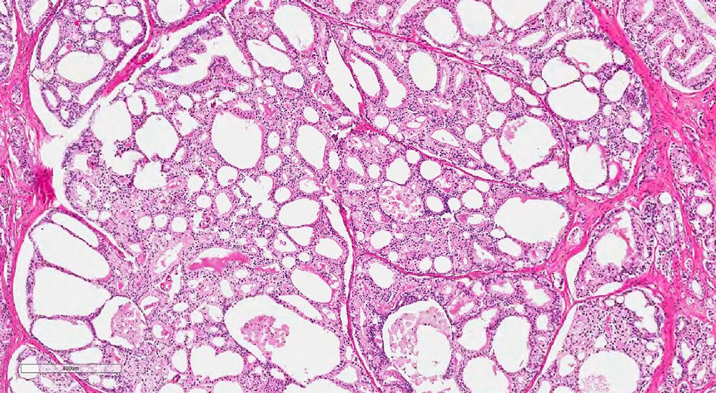 What do we know about those uncommon #prostatecancer?Take a look of this NEWEST review paper @uroonc, just released two days ago:
sciencedirect.com/science/articl… Understanding of tumor biology will foster the ongoing development of targeted therapies, and better clinical decision making.