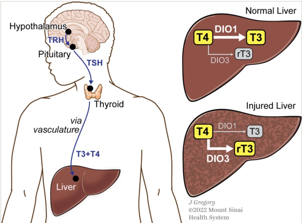 FosterDrugInfo's tweet photo. 💊#Resmetirom (#Rezdiffra™️):
✅A New #FDA_Approved Treatment of Non-alcoholic Fatty Liver Disease (#NAFLD) and Non-alcoholic #Steatohepatitis (#NASH)
✅Resmetirom is a liver-directed, orally active, selective #Thyroid_Hormone Receptor-β Agonist.
🔗 https://t.co/IKr4UYItIq https://t.co/r8vRx5yLBL