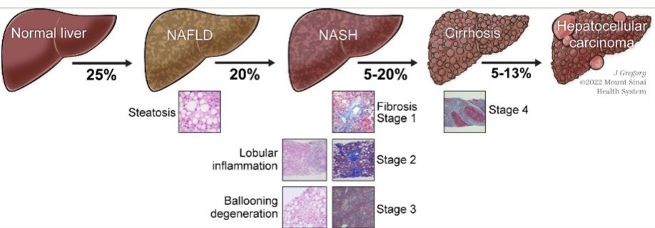 FosterDrugInfo's tweet photo. 💊#Resmetirom (#Rezdiffra™️):
✅A New #FDA_Approved Treatment of Non-alcoholic Fatty Liver Disease (#NAFLD) and Non-alcoholic #Steatohepatitis (#NASH)
✅Resmetirom is a liver-directed, orally active, selective #Thyroid_Hormone Receptor-β Agonist.
🔗 https://t.co/IKr4UYItIq https://t.co/r8vRx5yLBL