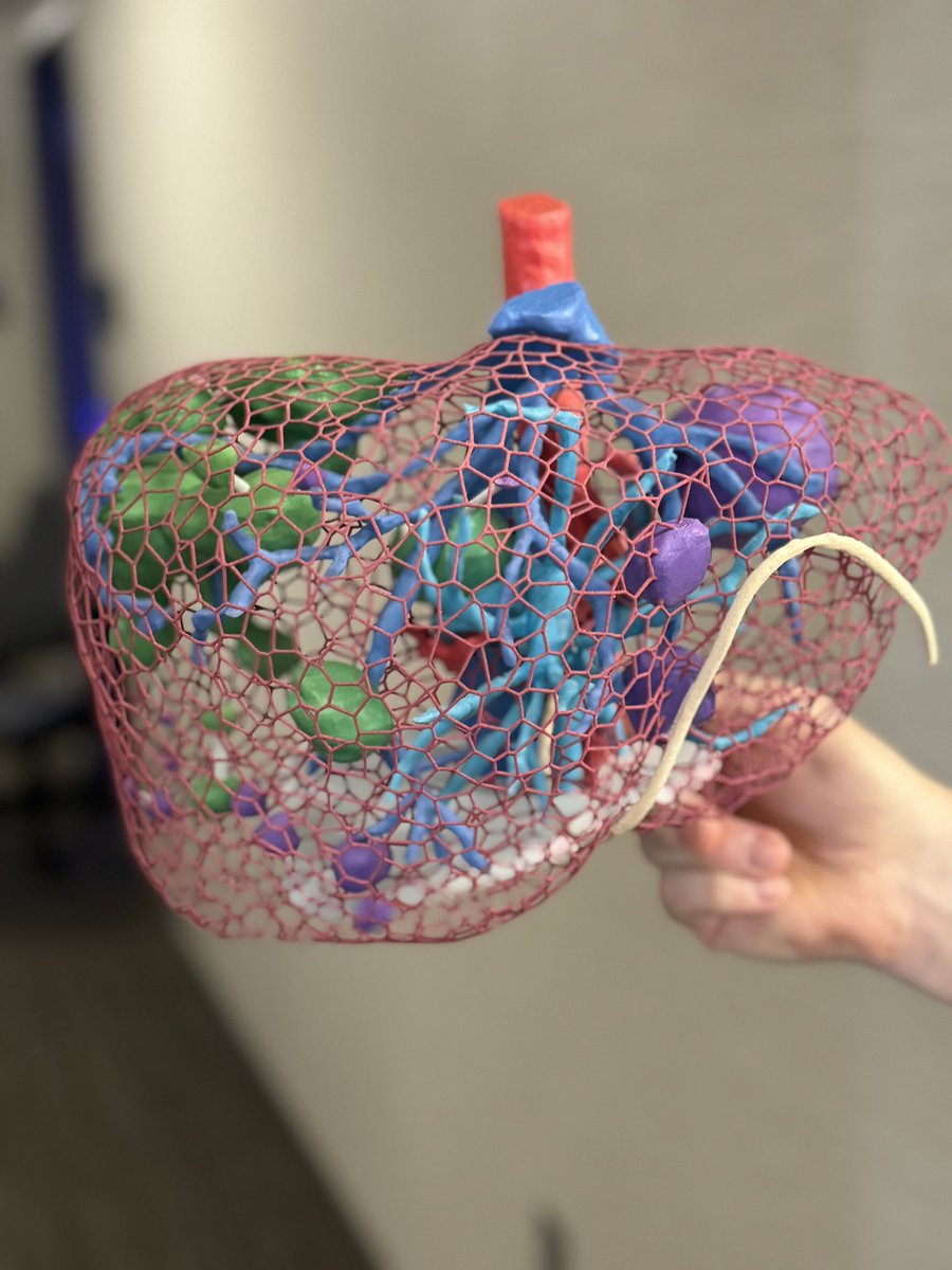 Surgical resection & microwave ablation planning for complex metastatic liver tumor treatment is aided by patient specific #3Dprinted models. @MayoClinic @mayoradiology #GI #hepatology #GITwitter #PatientCare #coloncancer #medtech #FOAMed #anatomy #liver #3D #3Dprinting
