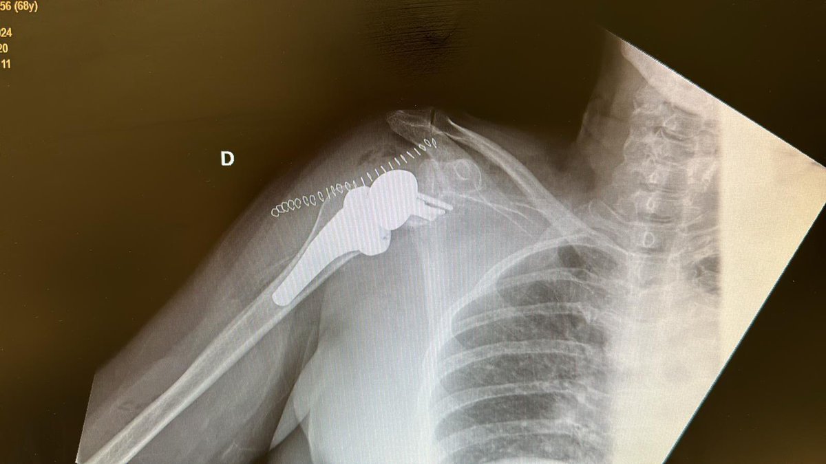🛑Even with great deformities both on humerus and glenoid one can plan for a #BIO #RSA 
✅Remove osteophytes from head to correctly place the guide for graft harvesting
✅ Remove osteophytes from glenoid to correctly place the base plate